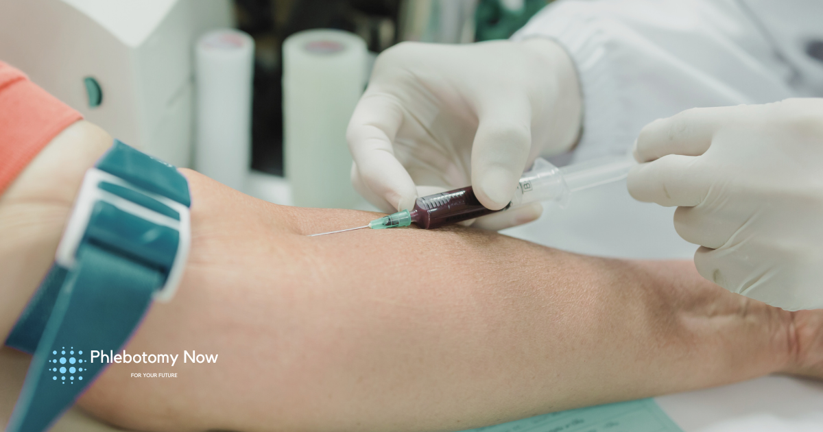 After Drawing Blood Bruising: Causes & Tips | Phlebotomy Now