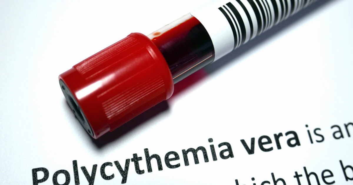 Polycythemia Vera: Understanding the Condition and Its Impact