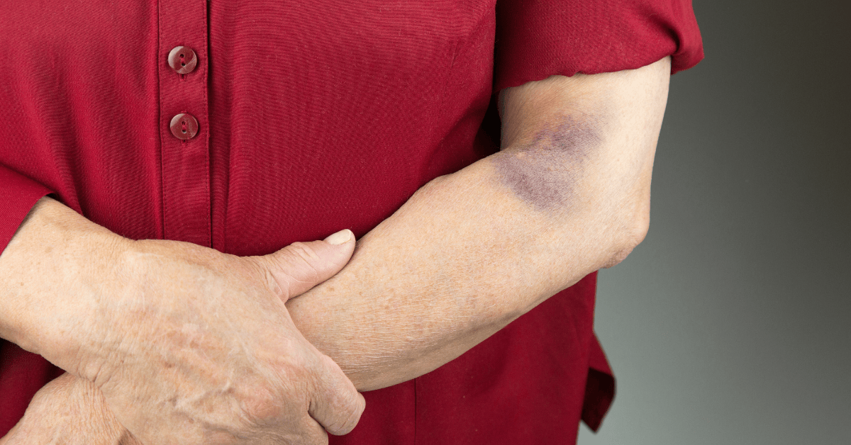 Hematoma: A Comprehensive Guide for Aspiring Phlebotomists